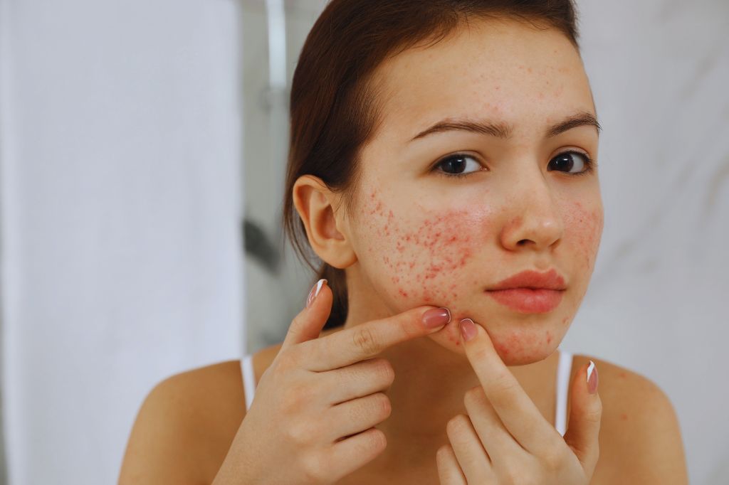 Hormonal Imbalance in Women