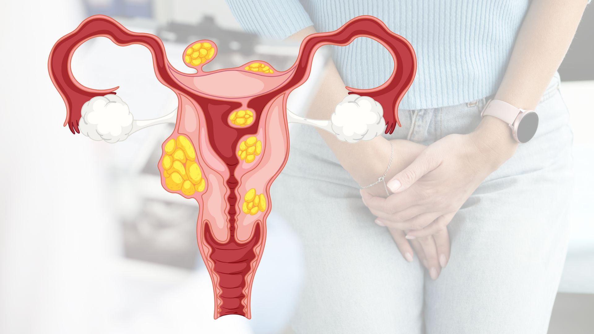 What Are Uterine Fibroids?