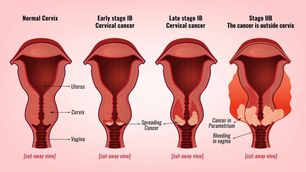 What Are the Early Warning Signs of Cervical Cancer?