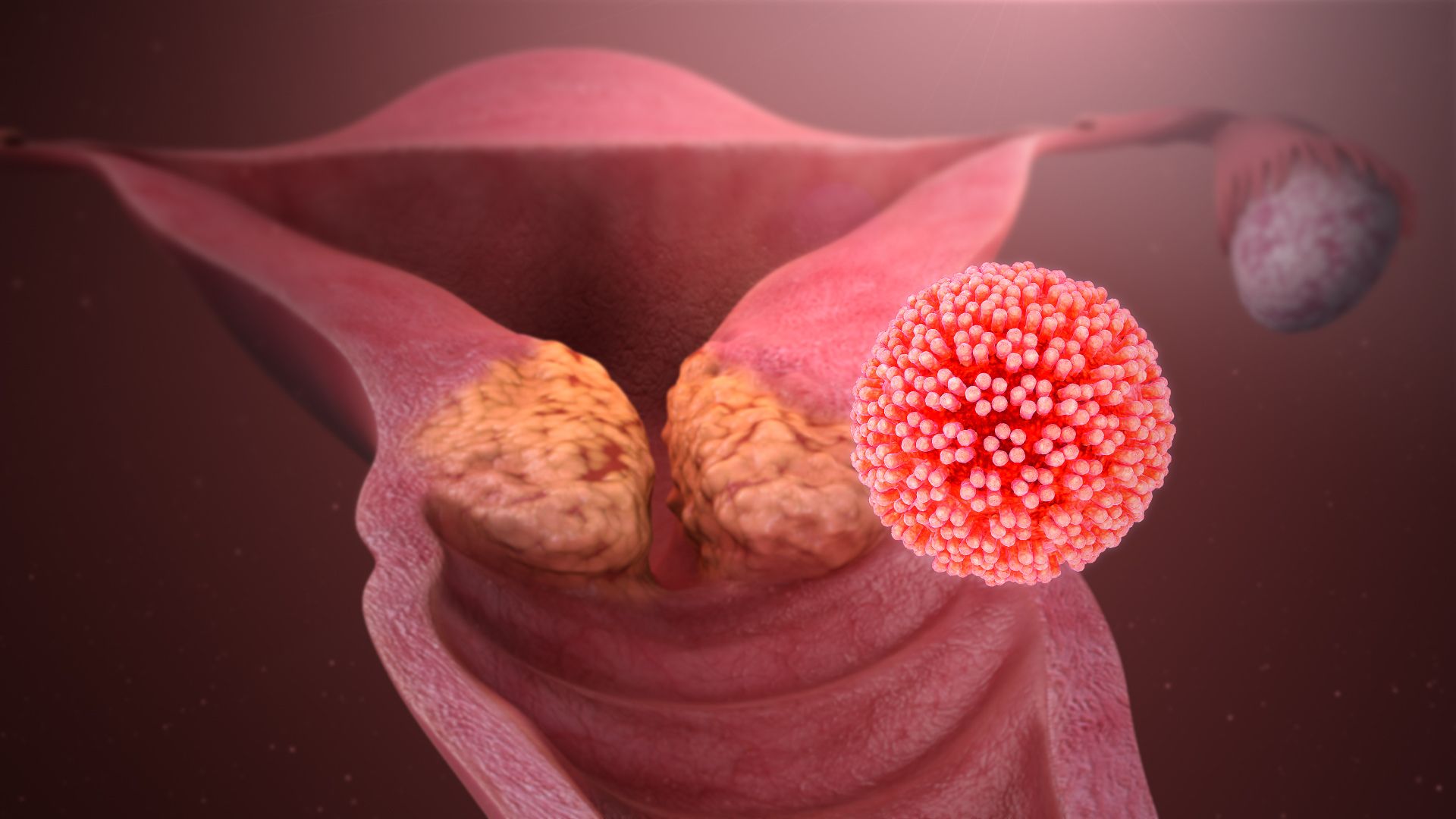 What Are the Early Warning Signs of Cervical Cancer?