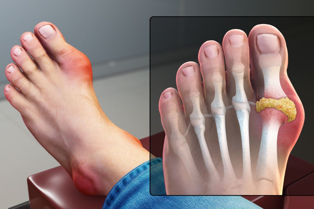 Early Signs of Gout to Never Ignore