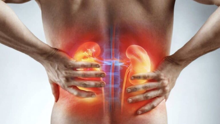 How to Differentiate Kidney Pain from Back Pain