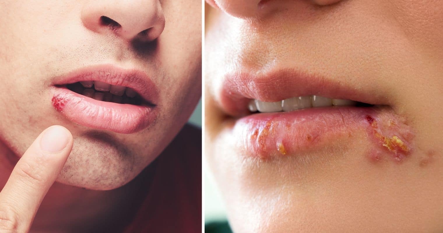 How to Treat Herpes Naturally