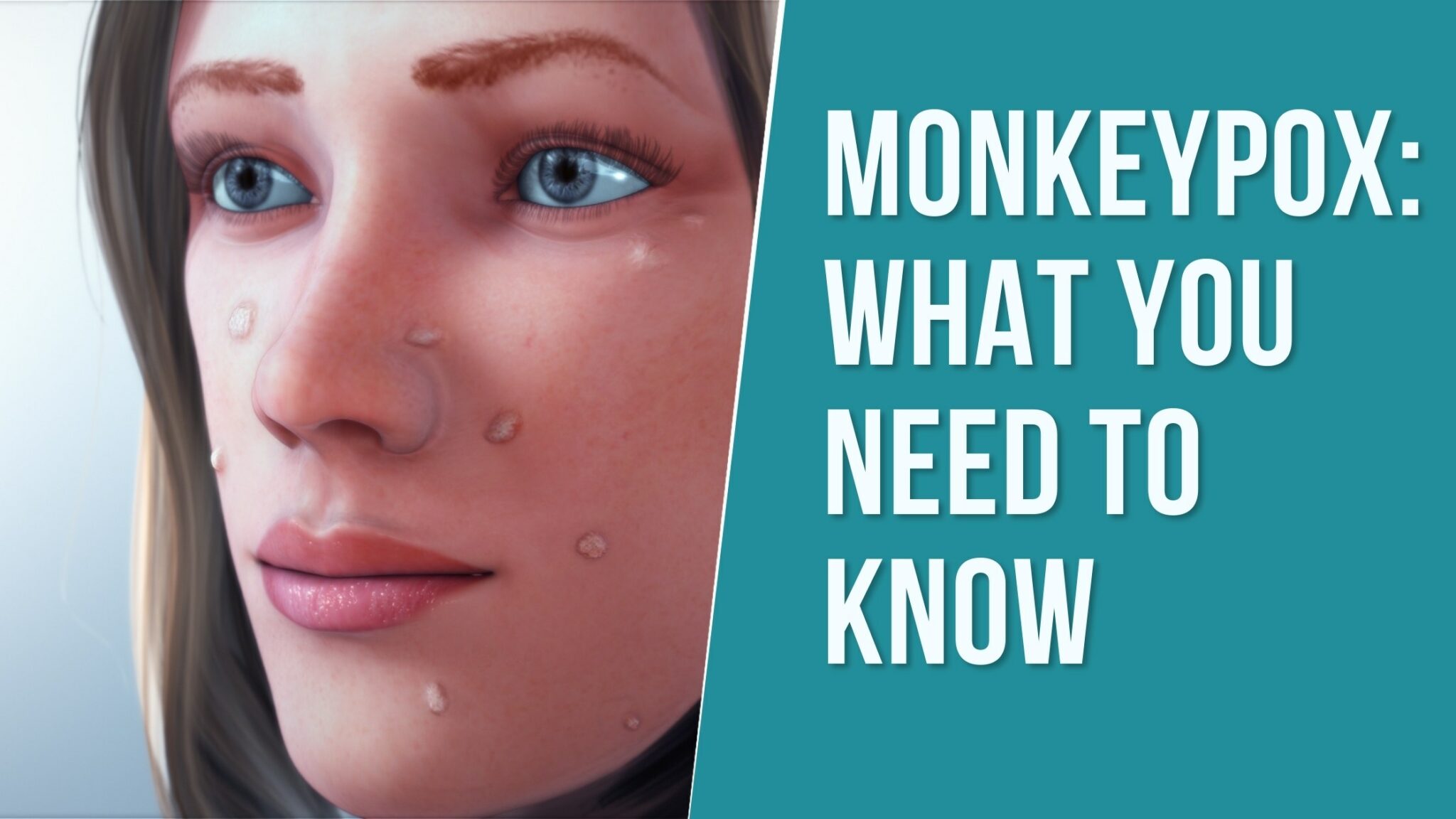 What is Monkeypox?