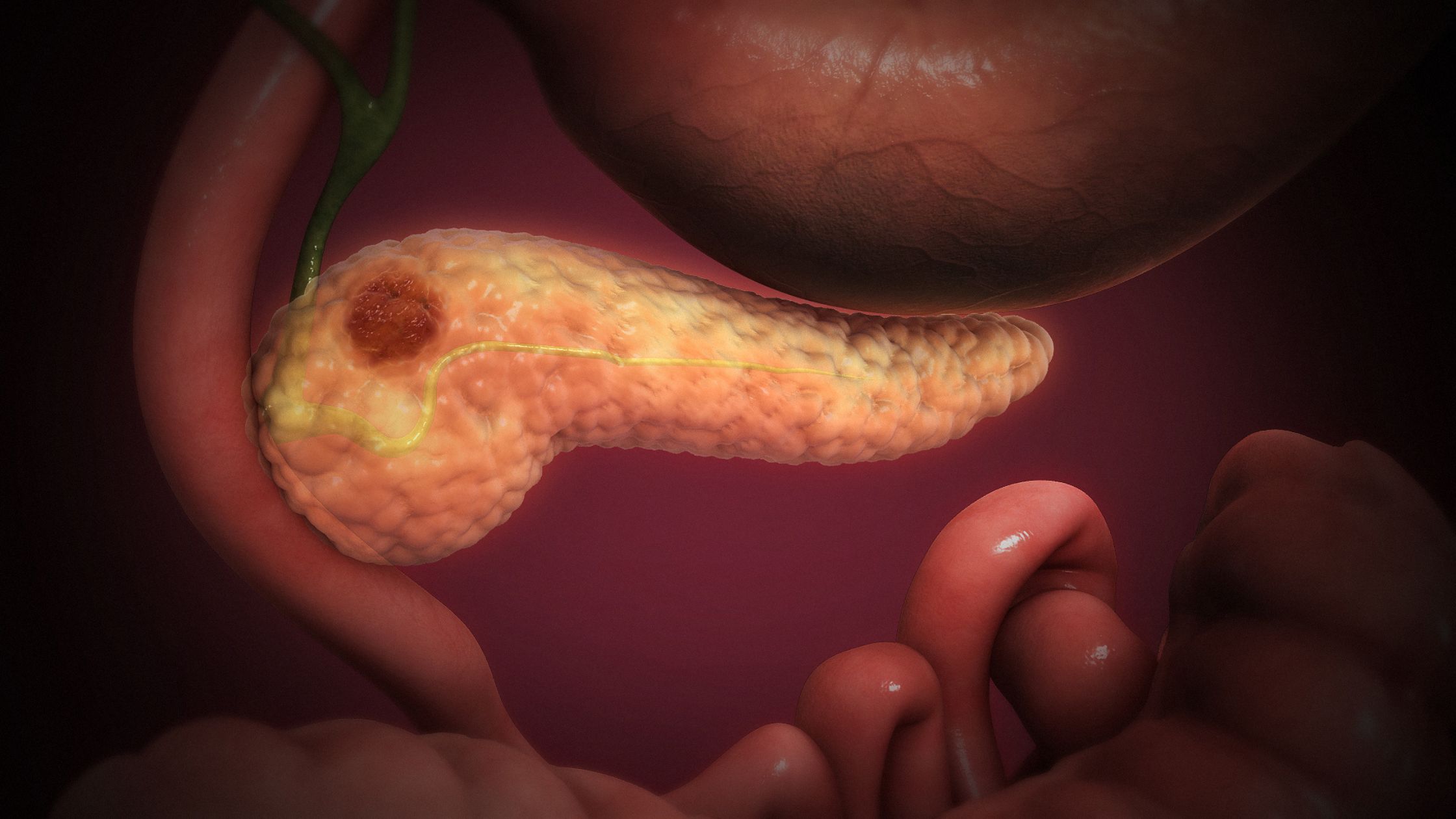 The Signs and Symptoms of Pancreatic Cancer