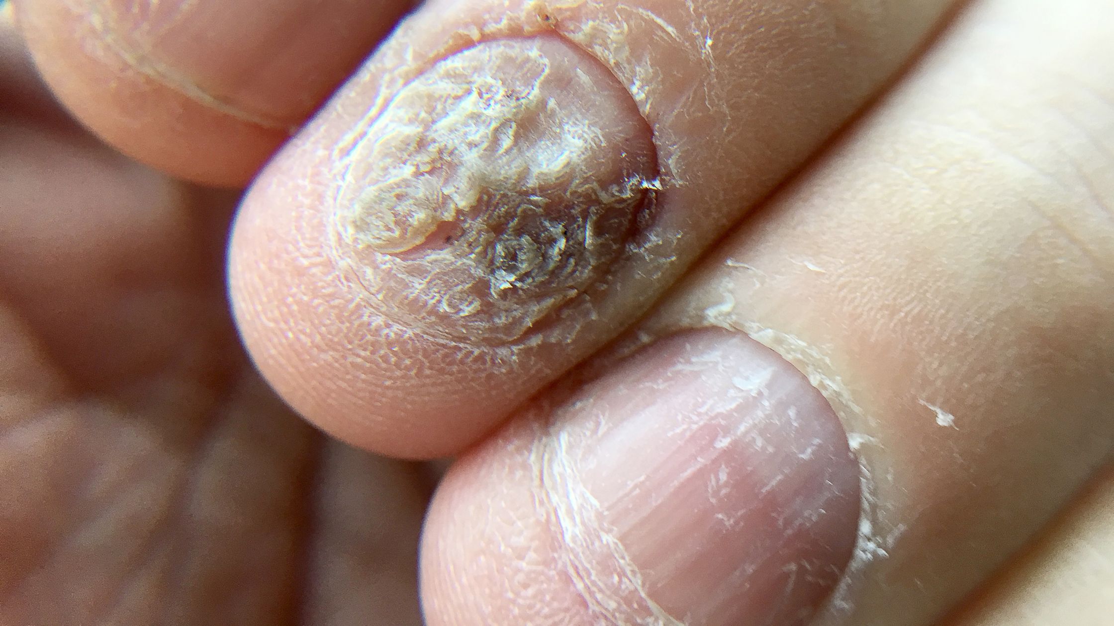 Remedies For Fungal Infections