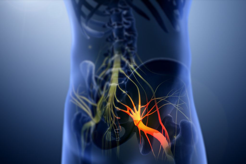 6 Signs of Sciatica Never to Overlook