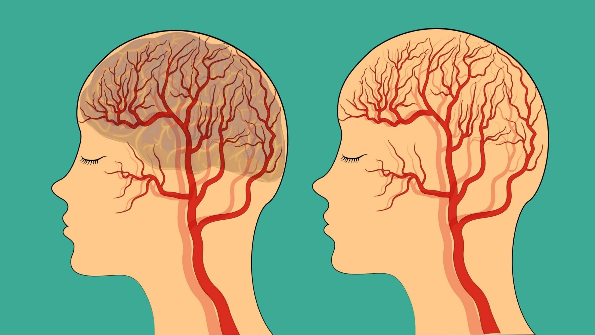 Signs And Symptoms Of Mini Stroke
