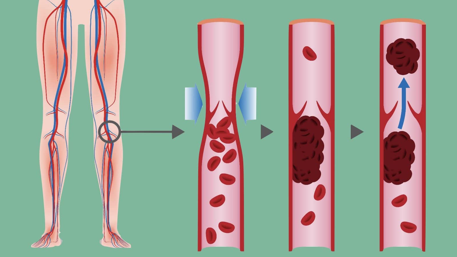 4 Warning Signs of a Blood Clot In Your Leg