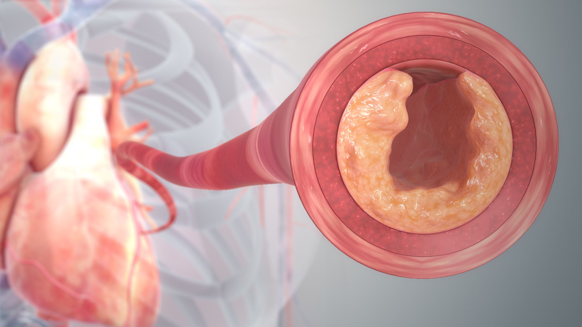 The Warning Signs Of Clogged Arteries