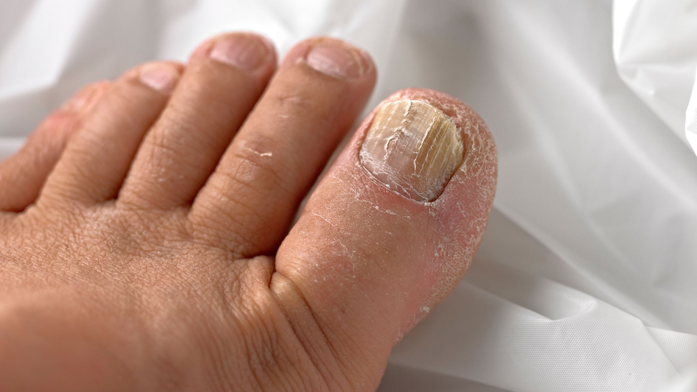 7 Home Remedies for Toenail Fungus