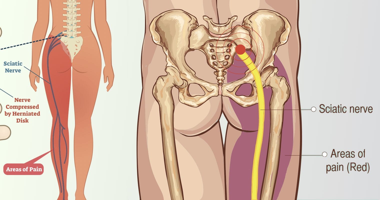 10 Ways to Ease Your Sciatica Pain