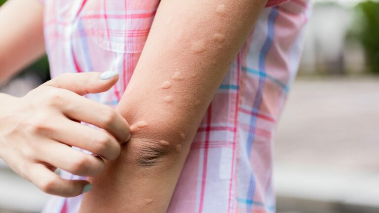 Prevent Mosquito Bites