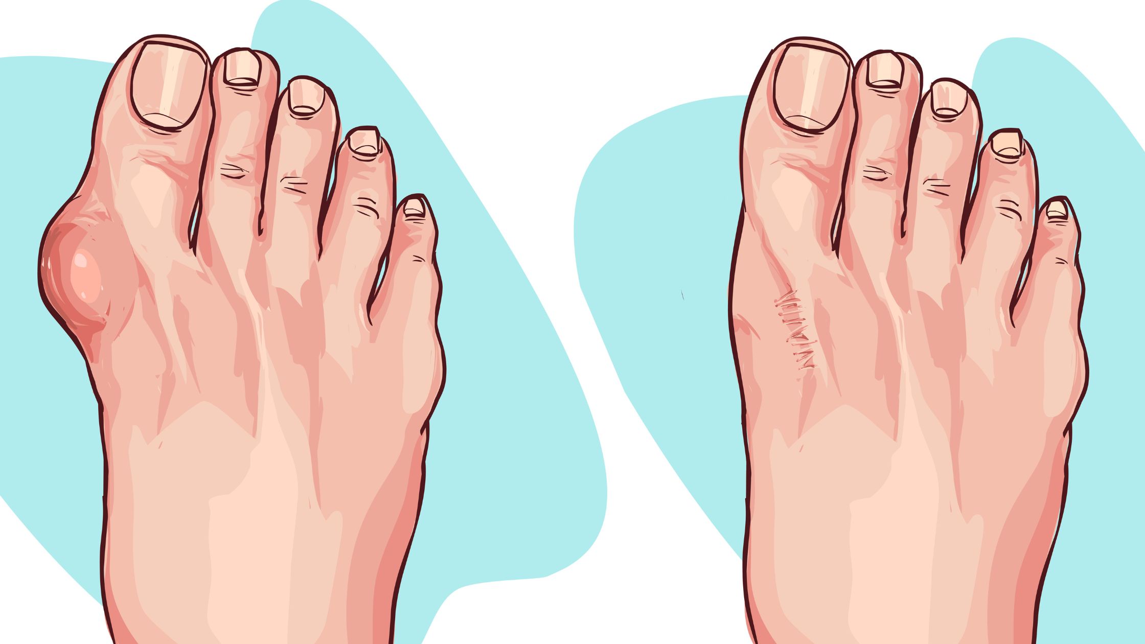 What Does Bunion Pain Feel Like