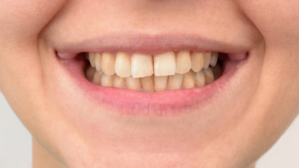 What Happens When You Don’t Brush Your Teeth Everyday