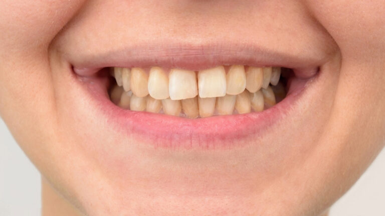 What Happens When You Don’t Brush Your Teeth Everyday