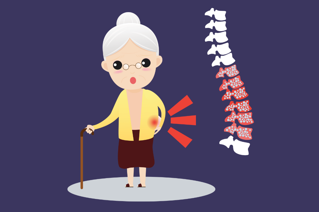 What Is Osteoporosis?