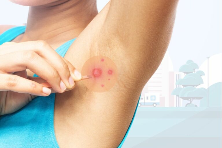 Why Am I Getting Pimples Under My Armpits