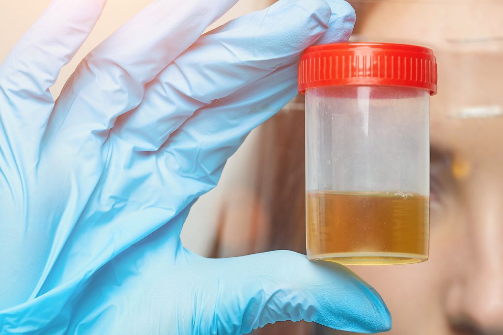 Why Is My Urine Dark