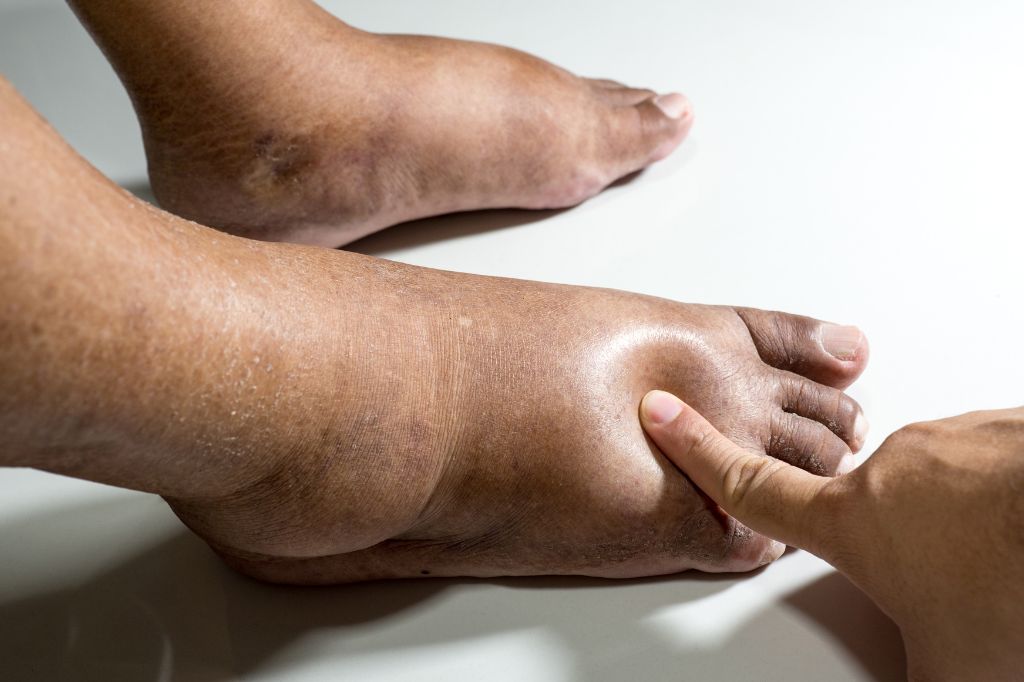Why You Have Swollen Feet, Ankles or Legs