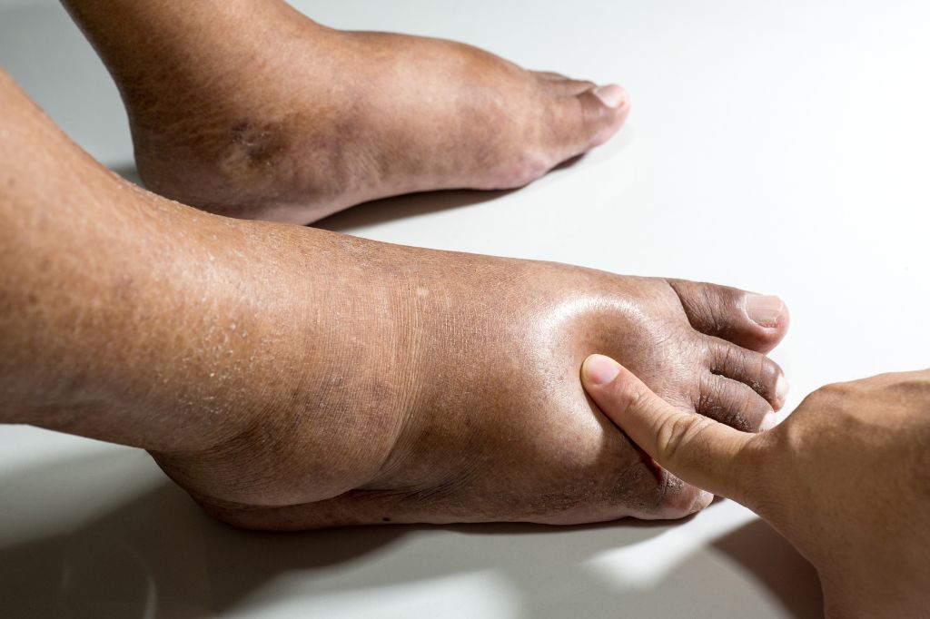 11 Reasons Why You Have Swollen Feet, Ankles or Legs