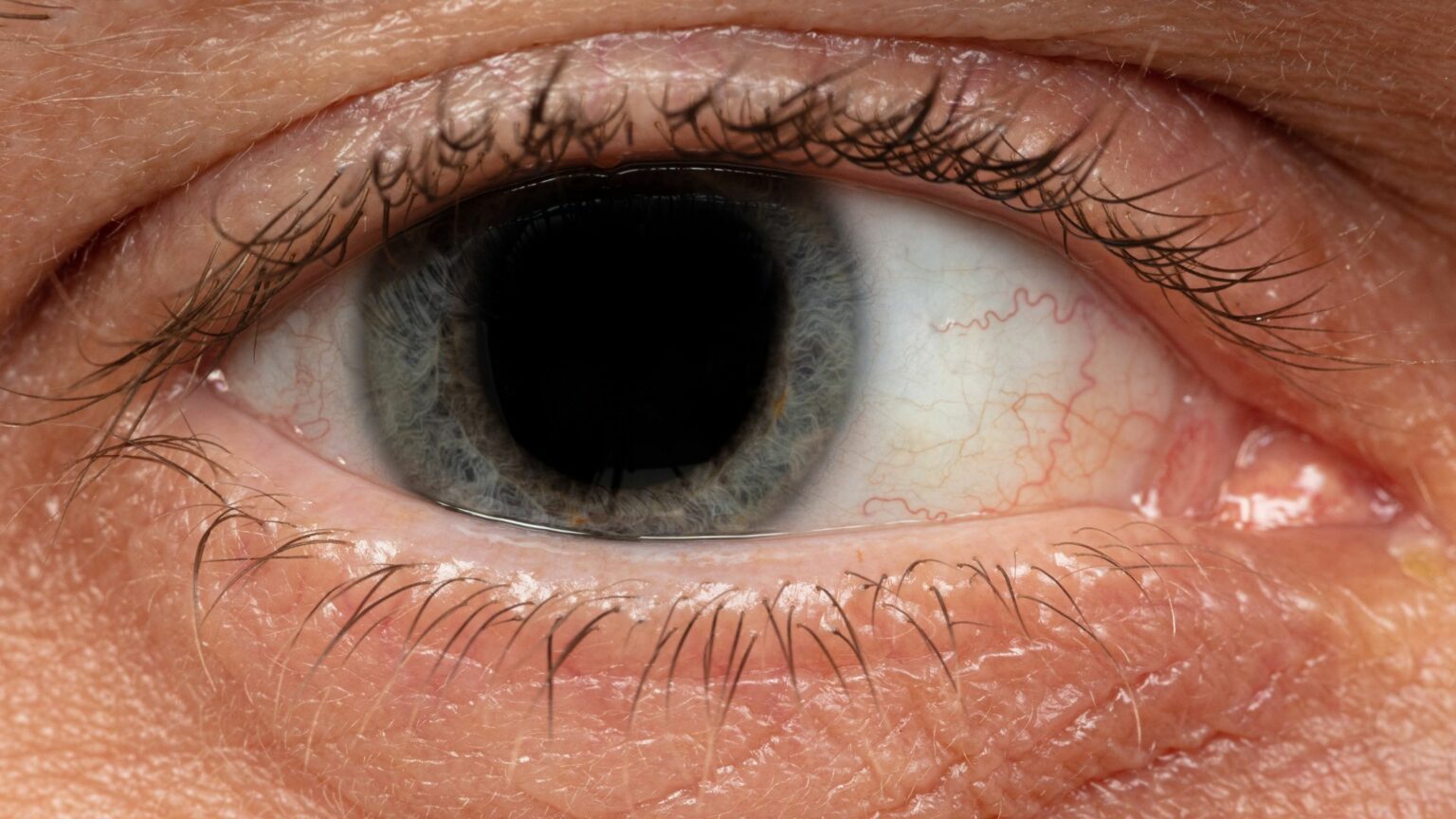 Why Are My Eyes Watery?