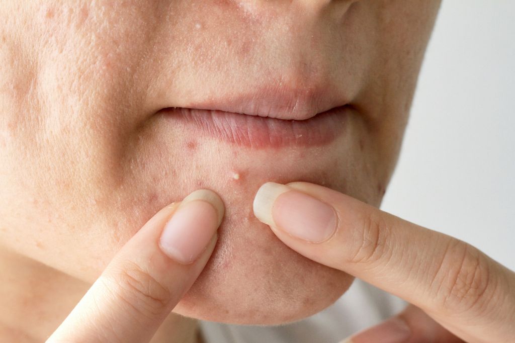 Superfoods for Oily and Acne-Prone Skin