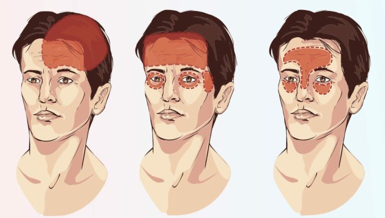 Types of Headaches