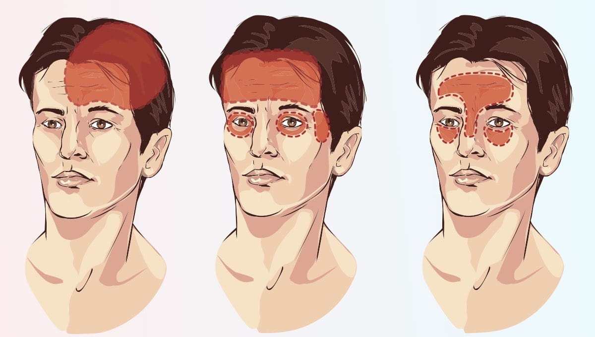 Types of Headaches