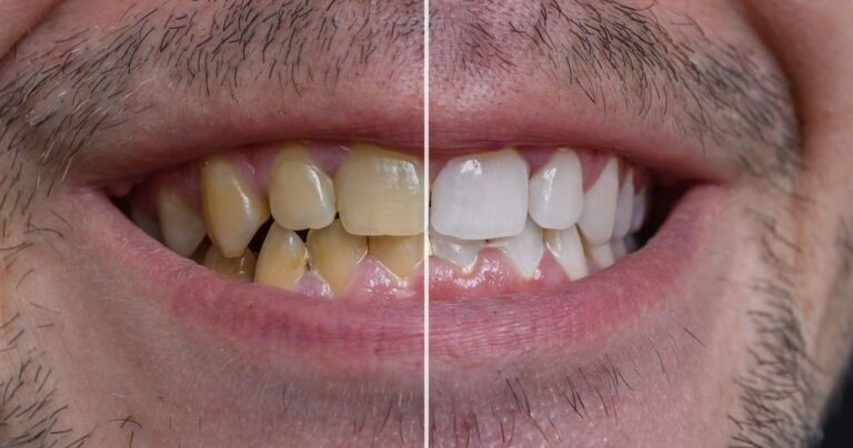 how to whiten teeth at home