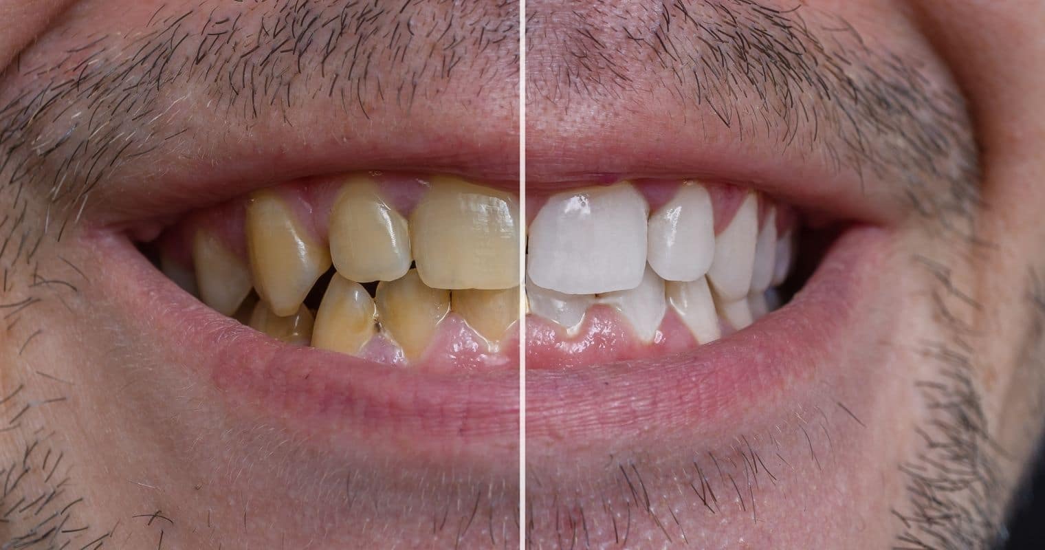 how to whiten teeth at home