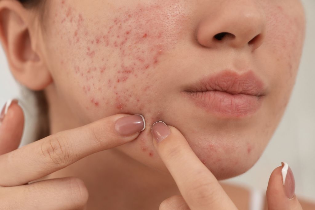 home remedies for pimples that will clear your skin in no time