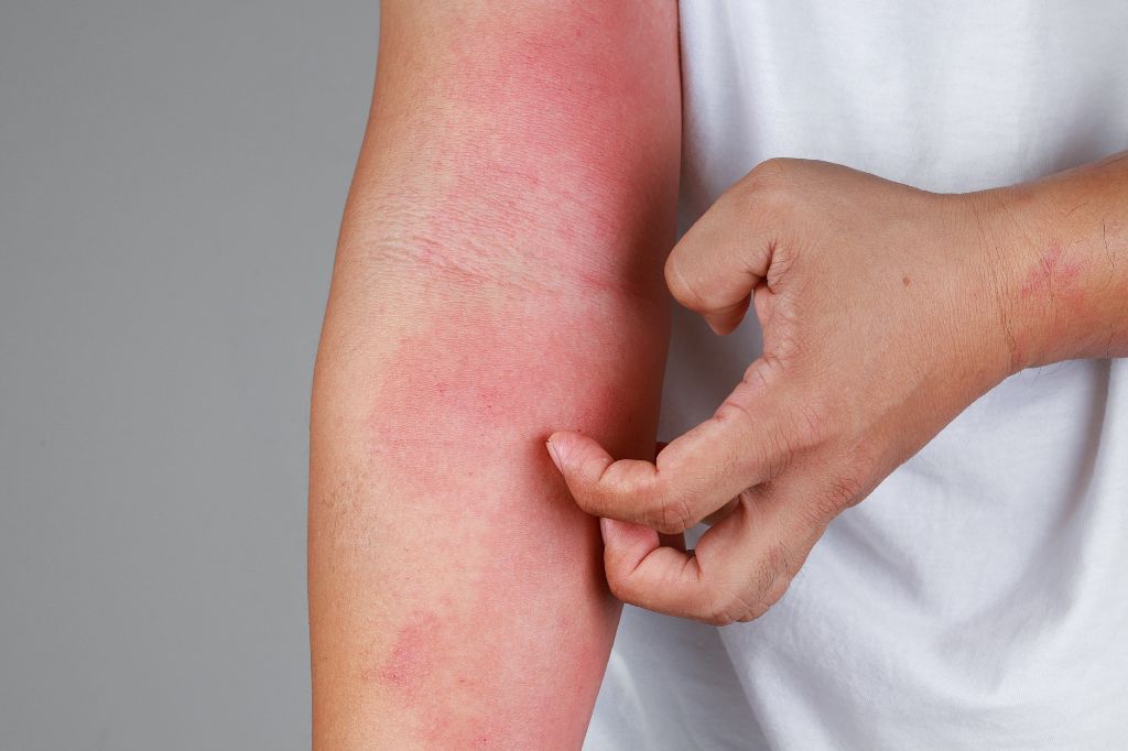 How to Get Rid of Itchy Skin