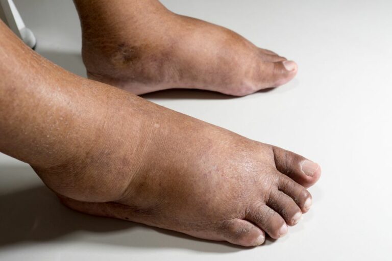 Ways to Get Rid of Water Retention