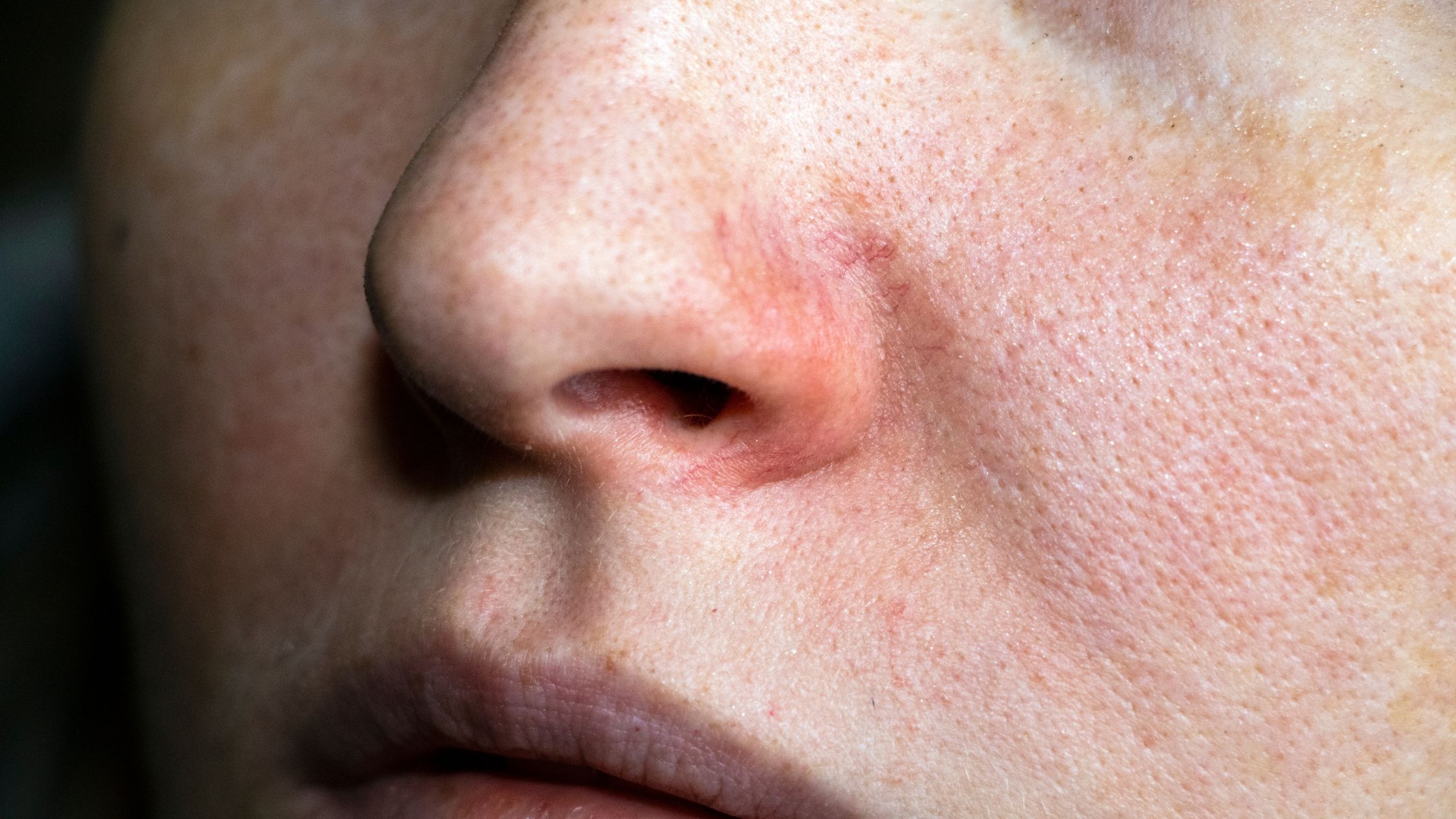 Early Signs of Lupus