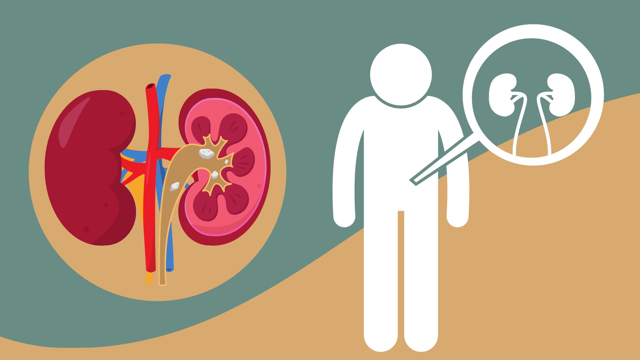 5 Early Symptoms of Kidney Stones You Shouldn’t Ignore