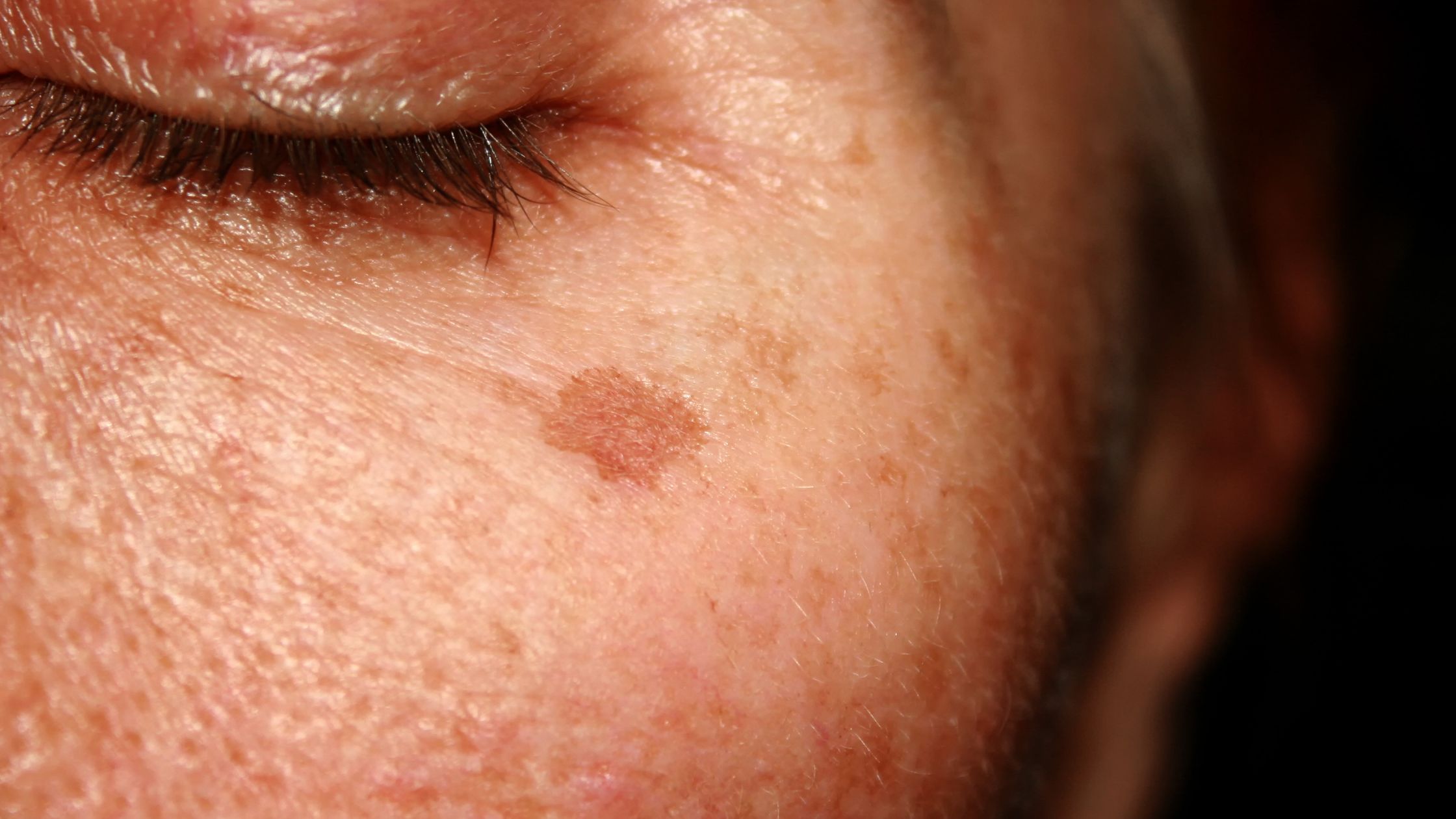 Natural Ways to Remove Brown Spots from Skin