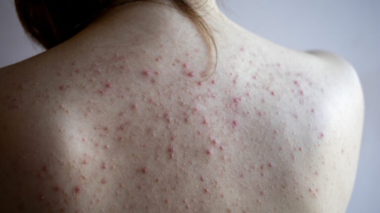Tips to Get Rid of Body Acne