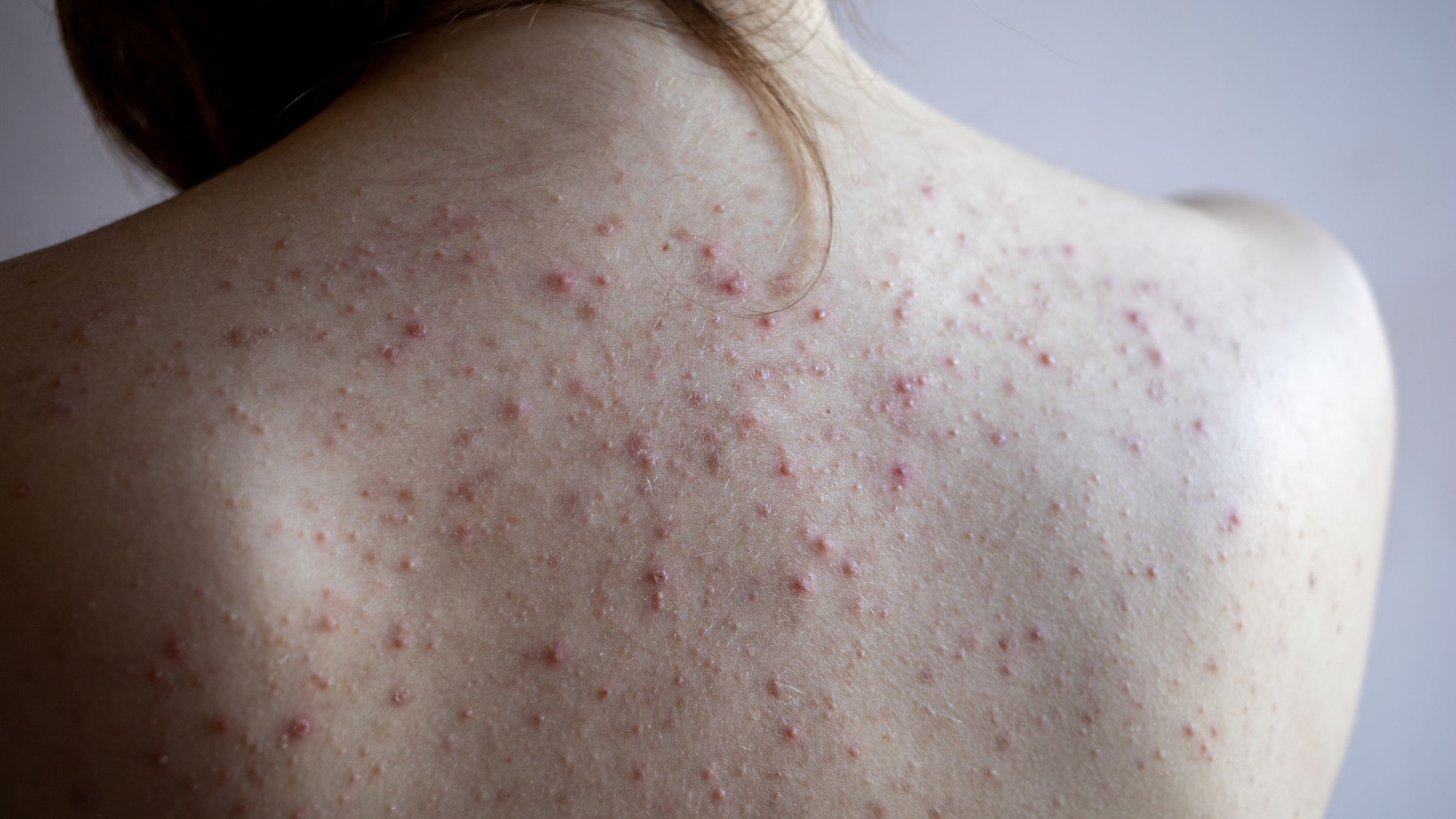 Tips to Get Rid of Body Acne