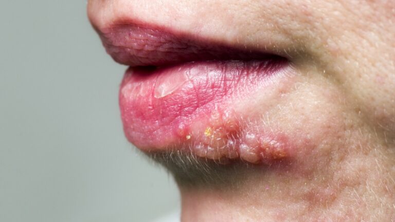 What are the symptoms of herpes?