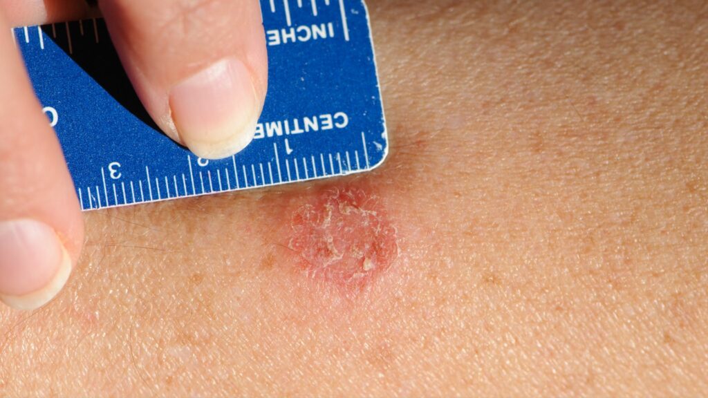 Home Remedies for Ringworm