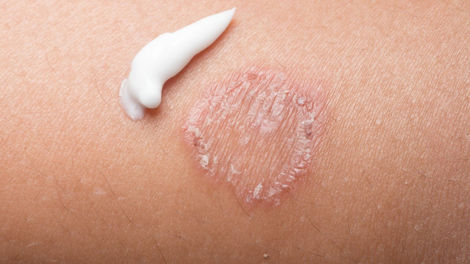 6 Home Remedies for Ringworm