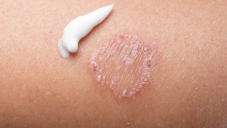 Home Remedies for Ringworm