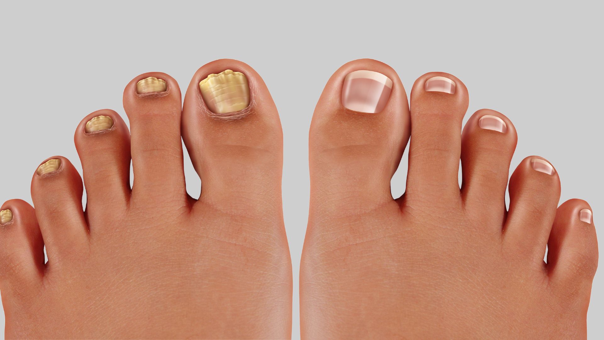 How to Treat Hard Yellow Toenails