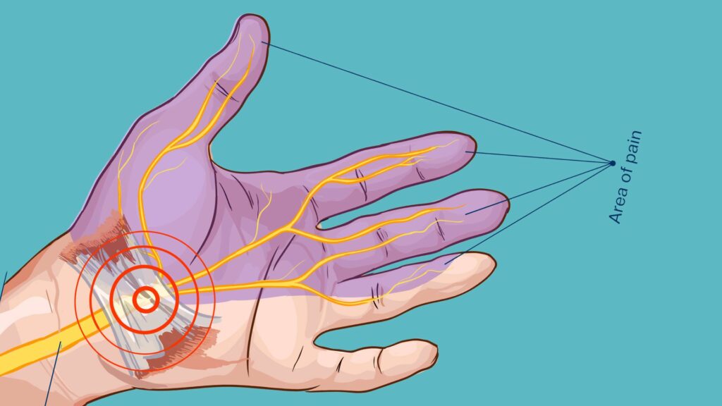 Symptoms of Low Calcium