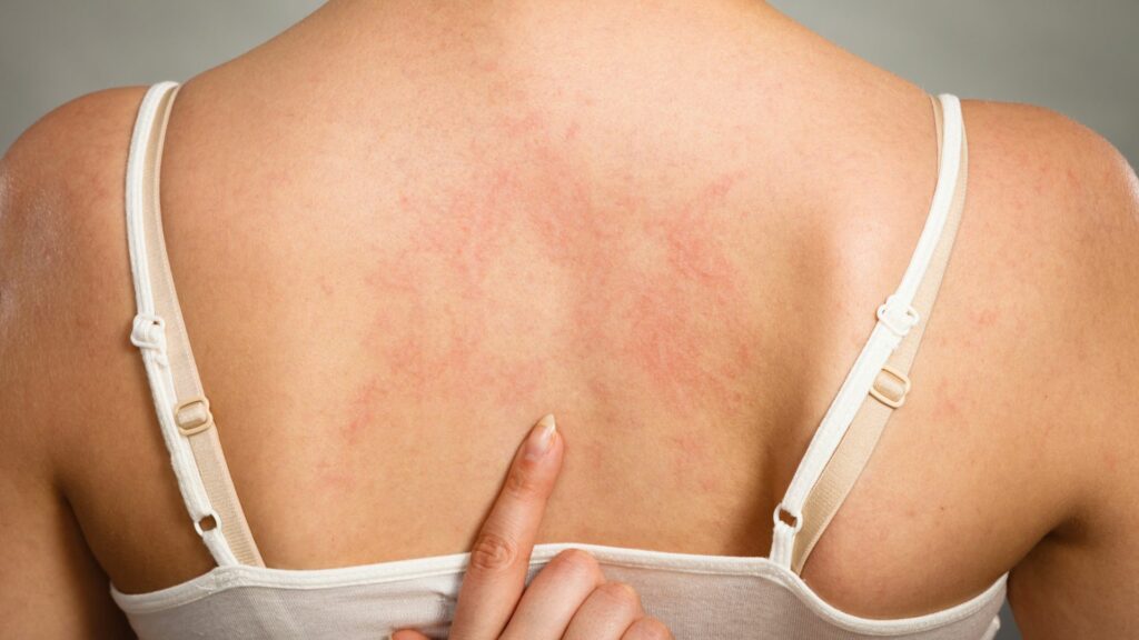 What Causes Hives