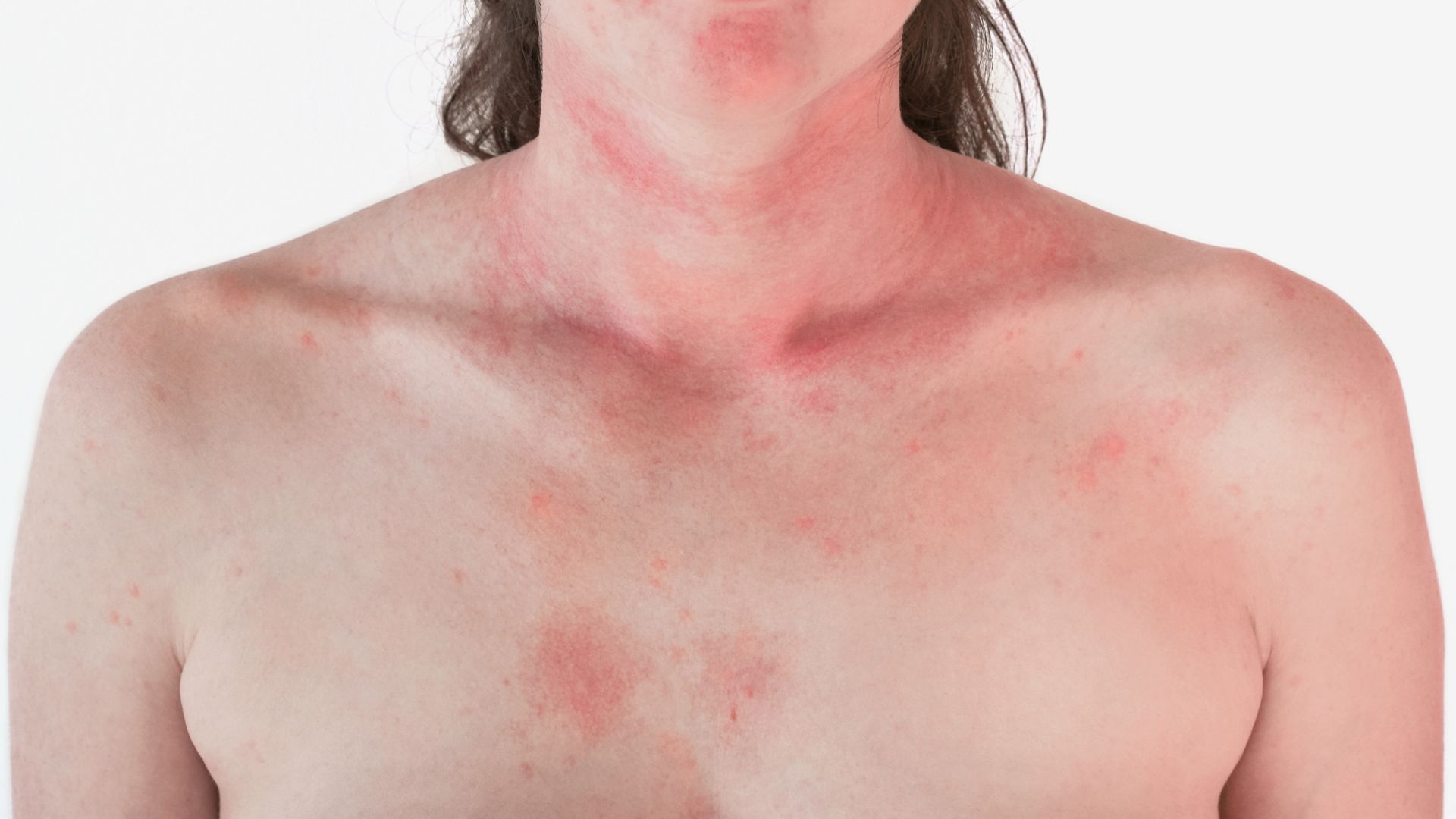 What Causes Hives