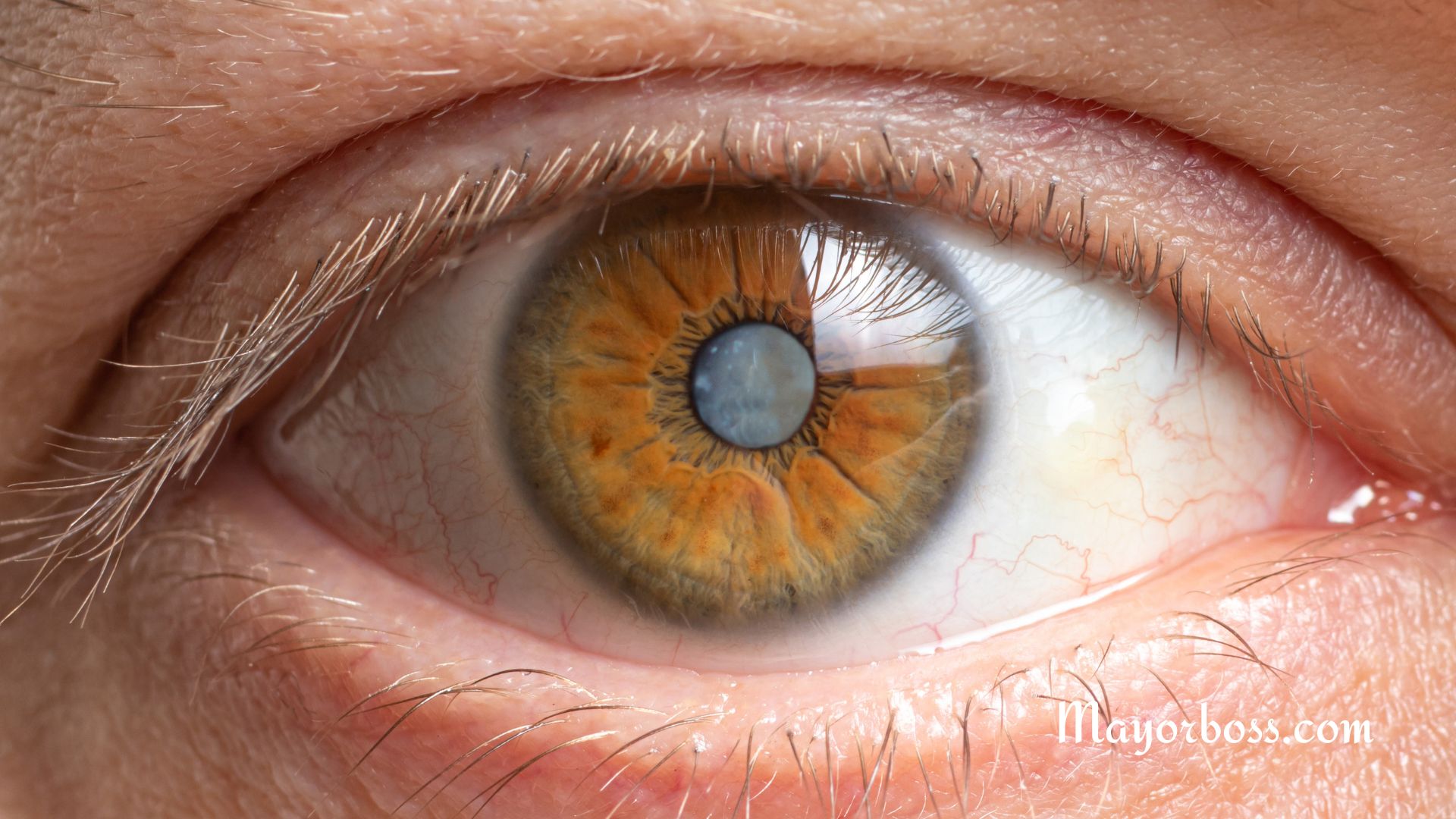 What Are Cataracts?