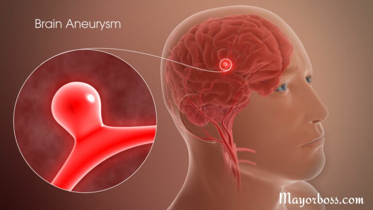 What Is a Brain Aneurysm?