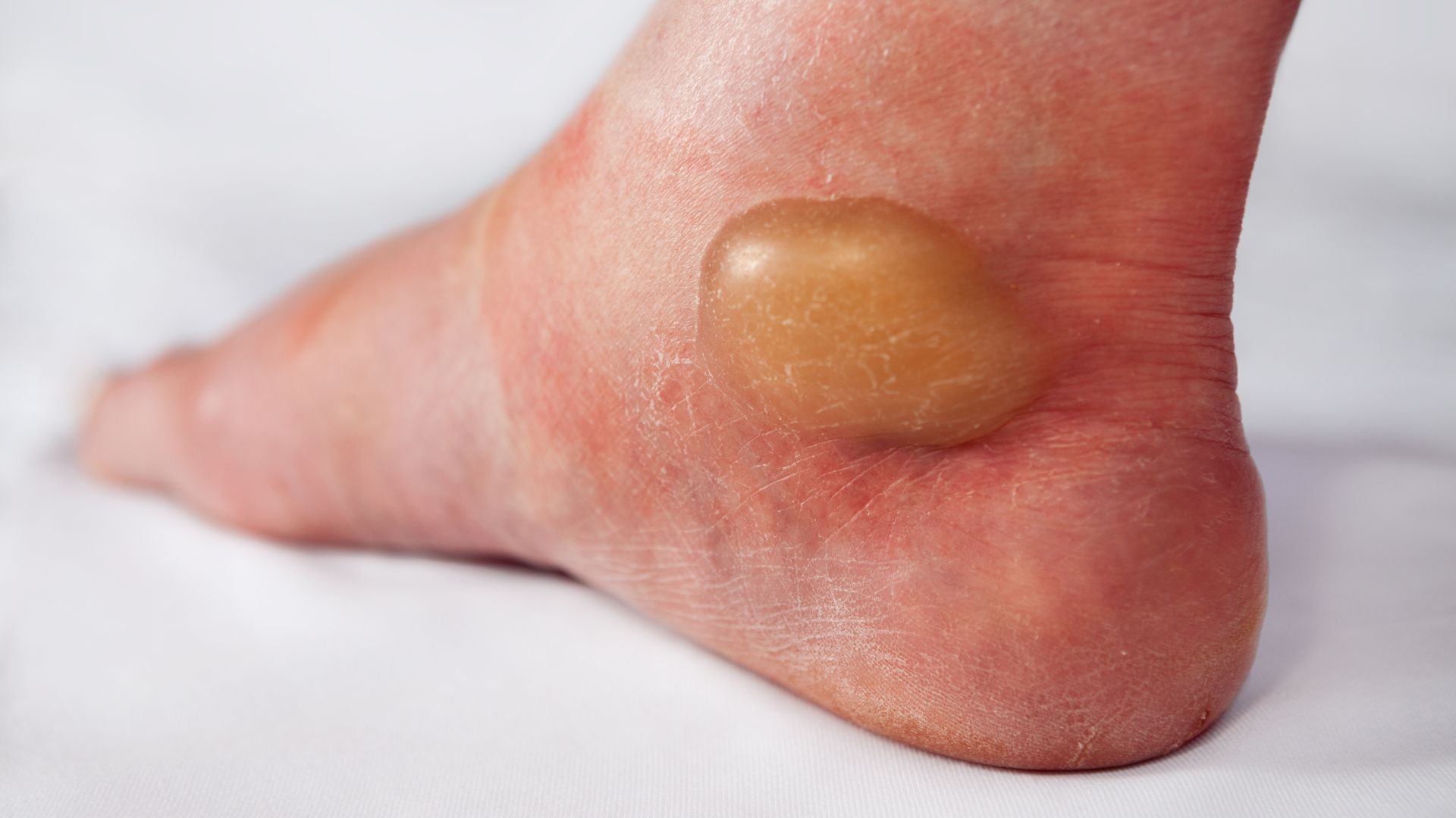 When Should You Pop a Blister?